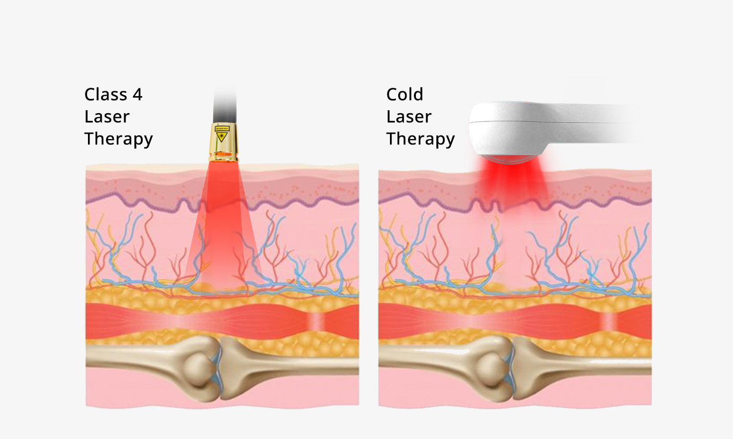 Cold Laser Therapy vs. Class 4 Laser Therapy