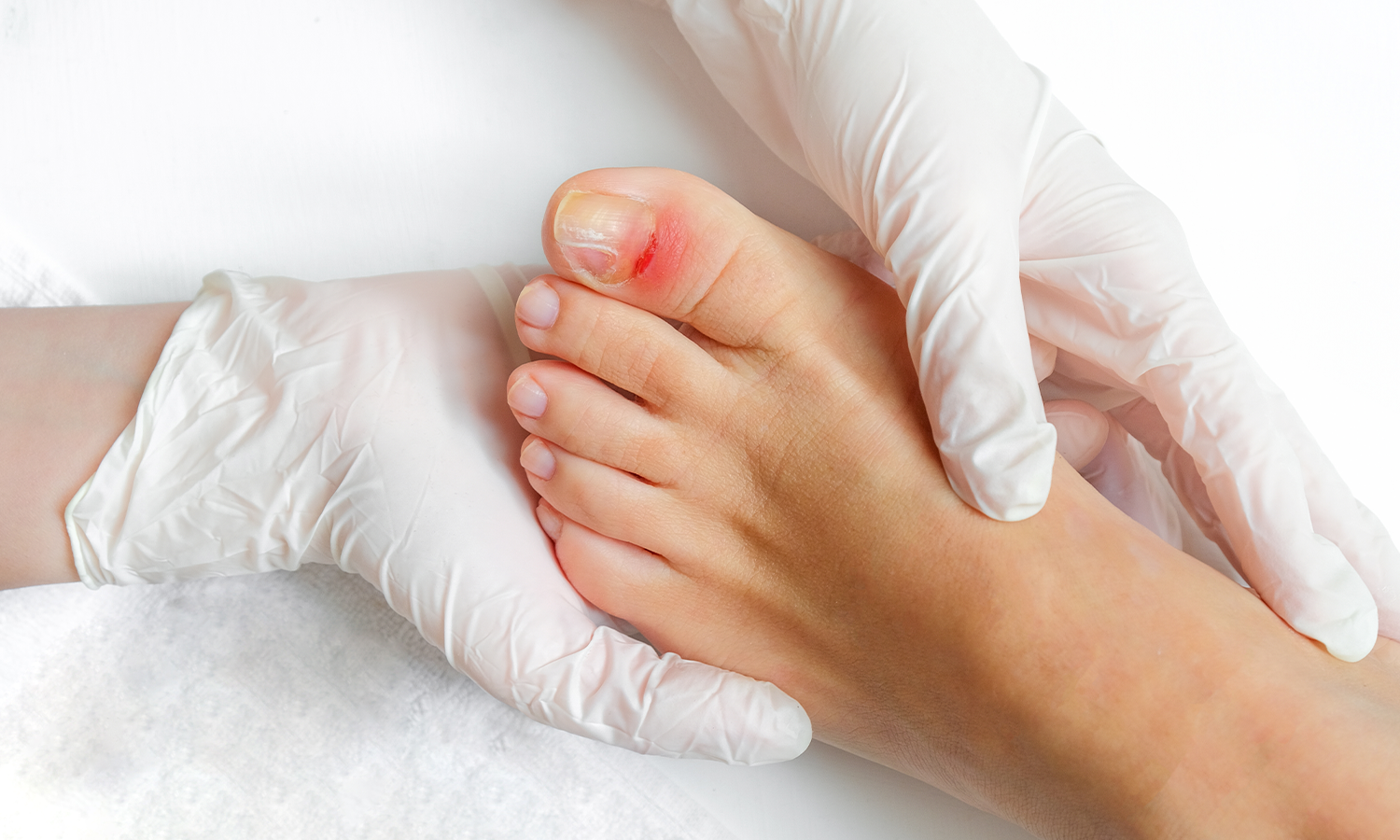 Laser Nail Therapy: Benefits, Guidance, and How It Works