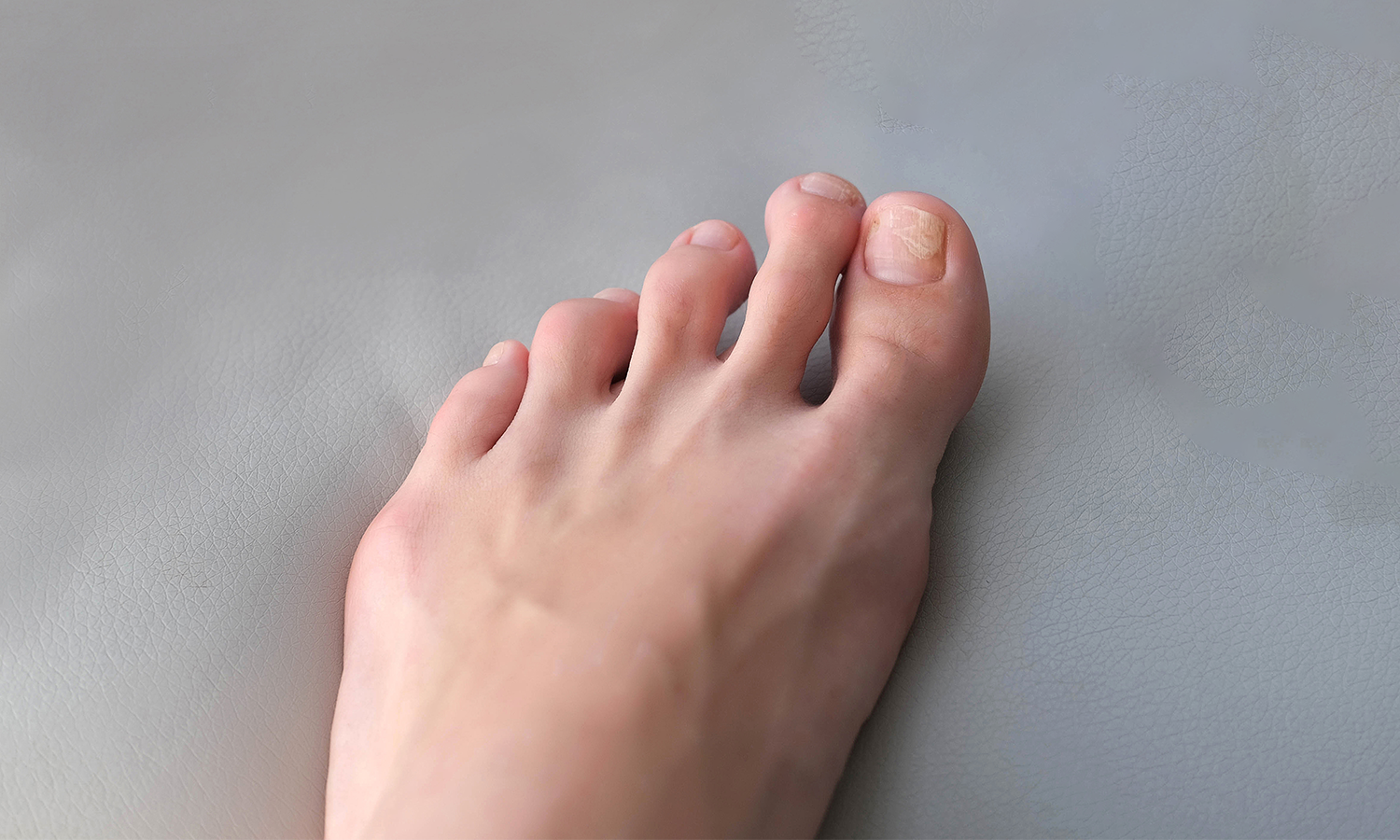 Toenail Terror? Laser’s Here to Save Your Sole!